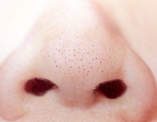 Ini Kondisi Medis yang Sebabkan Hidung Dipenuhi Upil