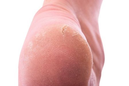 Cara Atasi Tumit Kering