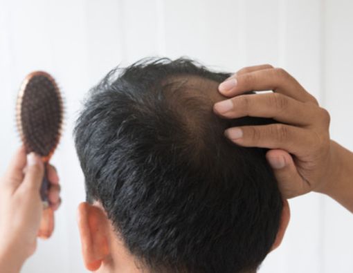 Rambut Rontok Berhubungan dengan Testosteron?