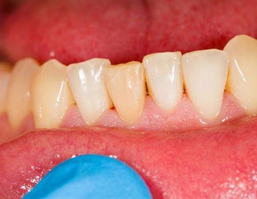 Apakah Penyebab dari Penyakit Gusi?