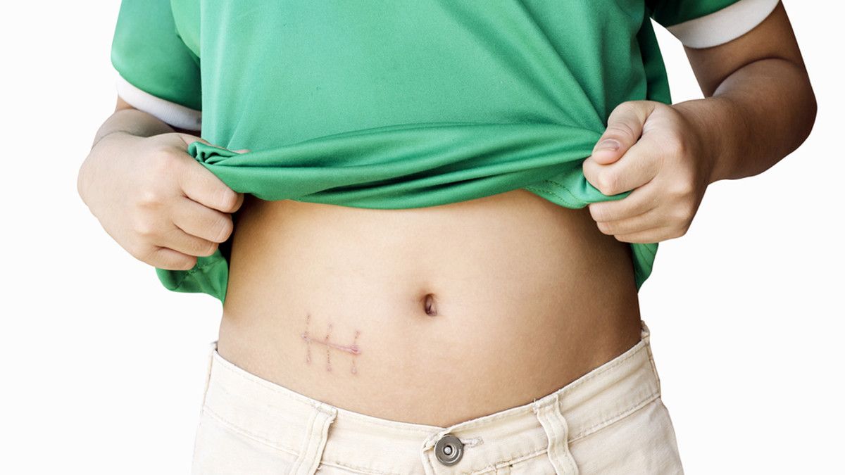 Waspadai Efek Samping Ini Usai Operasi Usus Buntu