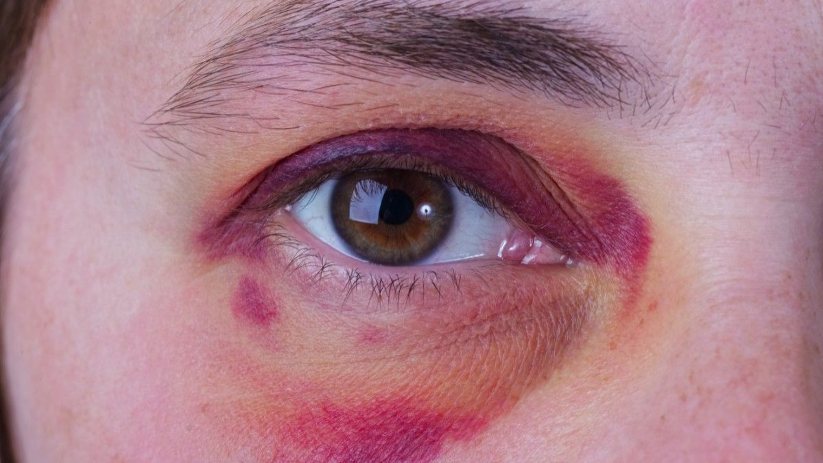 6 Cara Efektif Menghilangkan Memar di Mata