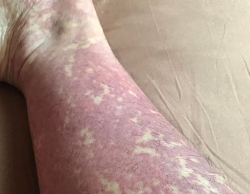 Henoch-Schonlein Purpura