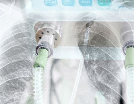 Terapi ECMO Kurangi Risiko Kematian Pasien COVID-19