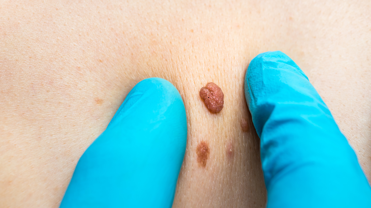 Skin Tag | Coterie Clinic