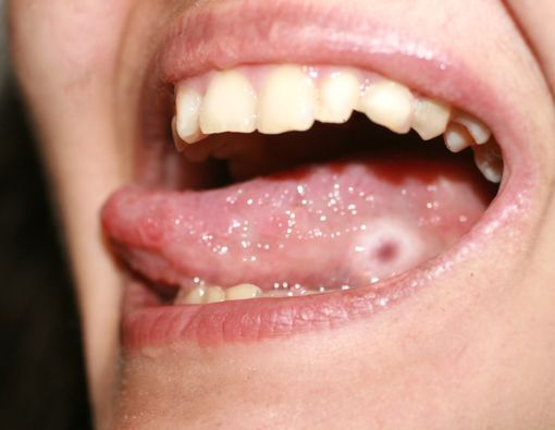 Kena Sifilis di Mulut, Kenali Penyebabnya dan Cara Mengatasinya!
