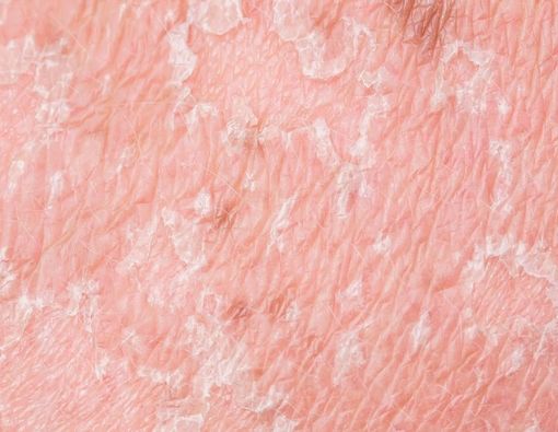 Cara Atasi Hiperpigmentasi saat Cuaca Panas dan Dingin