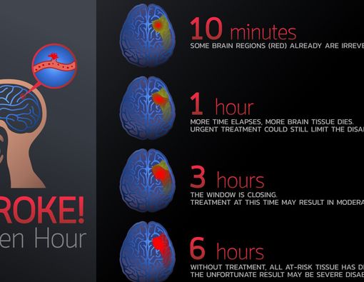 Ketahui ‘Golden Hour’ Penanganan Stroke demi Mencegah Dampak Fatal!