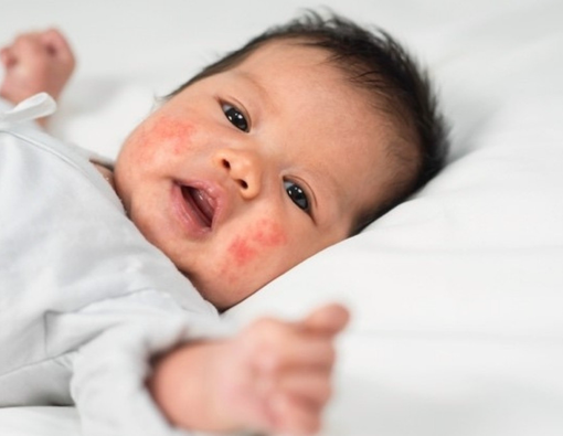 Kulit Sensitif Picu Eksim pada Bayi, Bisakah Dicegah?
