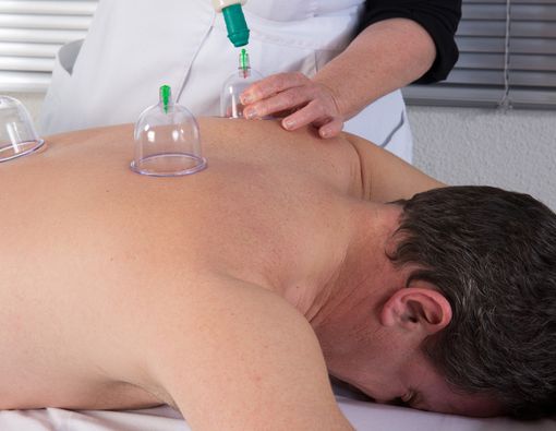 Efek Samping Terapi Bekam yang Perlu Anda Ketahui