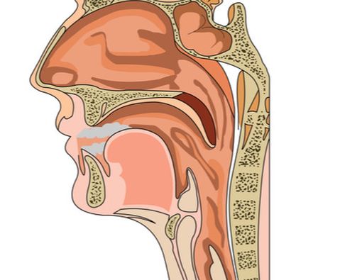 Infeksi Hidung dan Tenggorokan Bisa Picu Kanker Paru?
