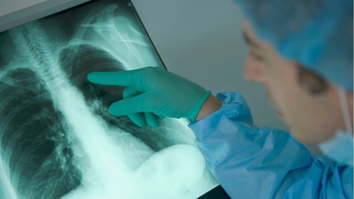 Penyebab Nodul Paru, Bintil Kecil Putih di Paru-Paru