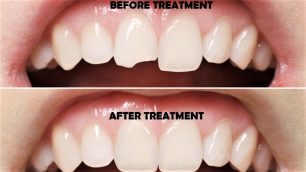 Dental Contouring, Perawatan Gigi Apa Pula Ini?
