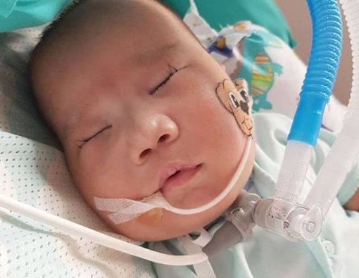 Mengenal Trisomi 13 yang Diderita Adam Fabumi