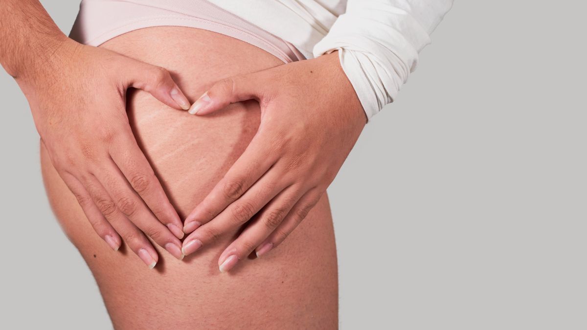 8 Penyebab Stretch Mark di Kulit