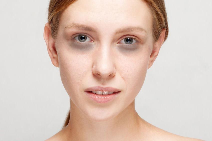 Mata Panda, Jangan- Jangan Kurang Darah?