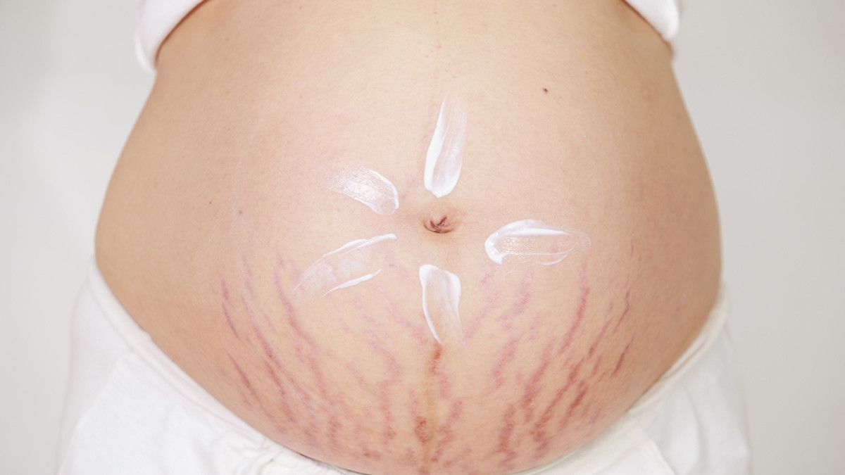 Bisakah Stretch Mark Hilang Total?