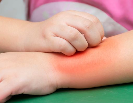 Anak Autisme Lebih Rentan Terkena Alergi?