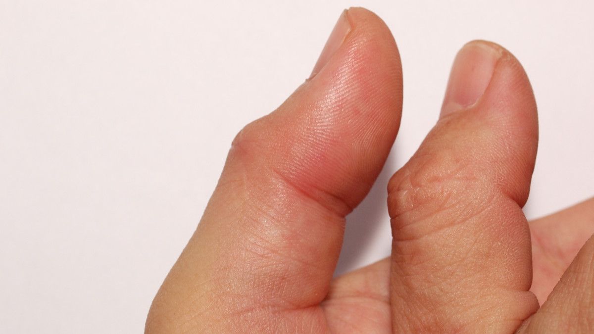 Penyebab Jempol Bengkak dan Cara Mengatasinya