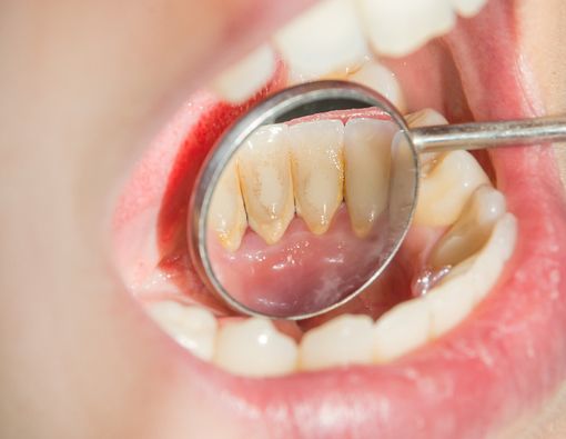 Yuk, Ketahui Bedanya Plak dan Karang Gigi