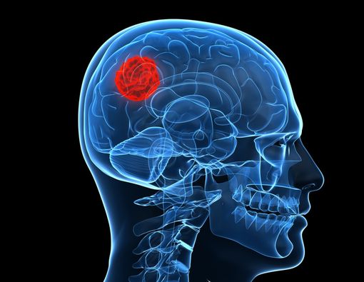 Mengenal Kanker Otak, Penyebab Agung Hercules Meninggal Dunia