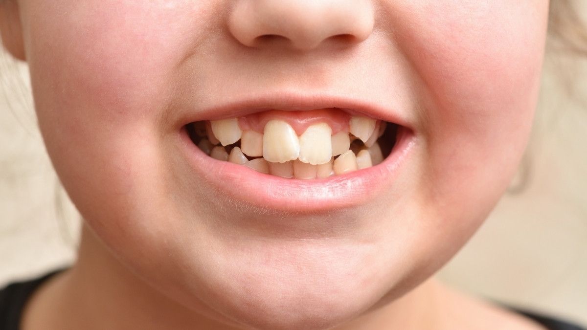 Kenali Ciri-Ciri Gigi Gingsul pada Anak, Bisakah Dicegah?