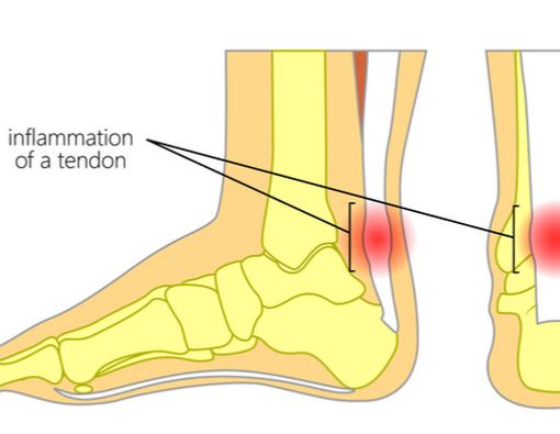 Tendinitis Achilles
