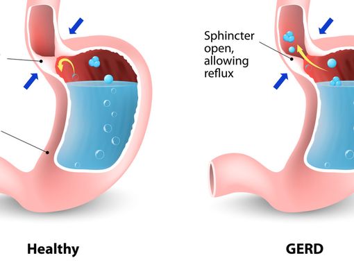 Pedoman Hidup Sehat untuk Penderita GERD
