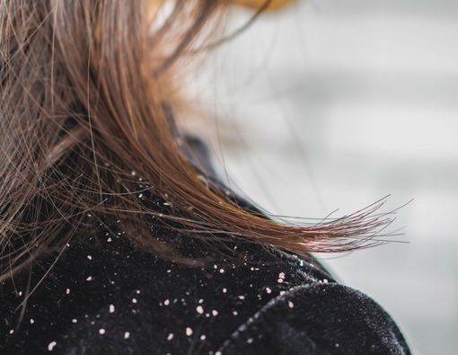 Hilangkan Ketombe dengan Garam, Mitos atau Fakta?