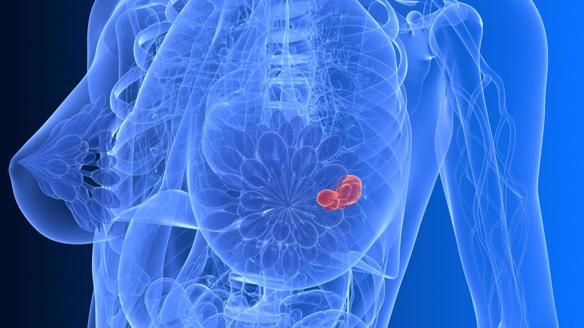 Kanker Payudara HER2 Positif, Bisakah Disembuhkan?