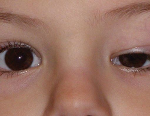 Ptosis pada Kelopak Mata Bolehkah Dioperasi?