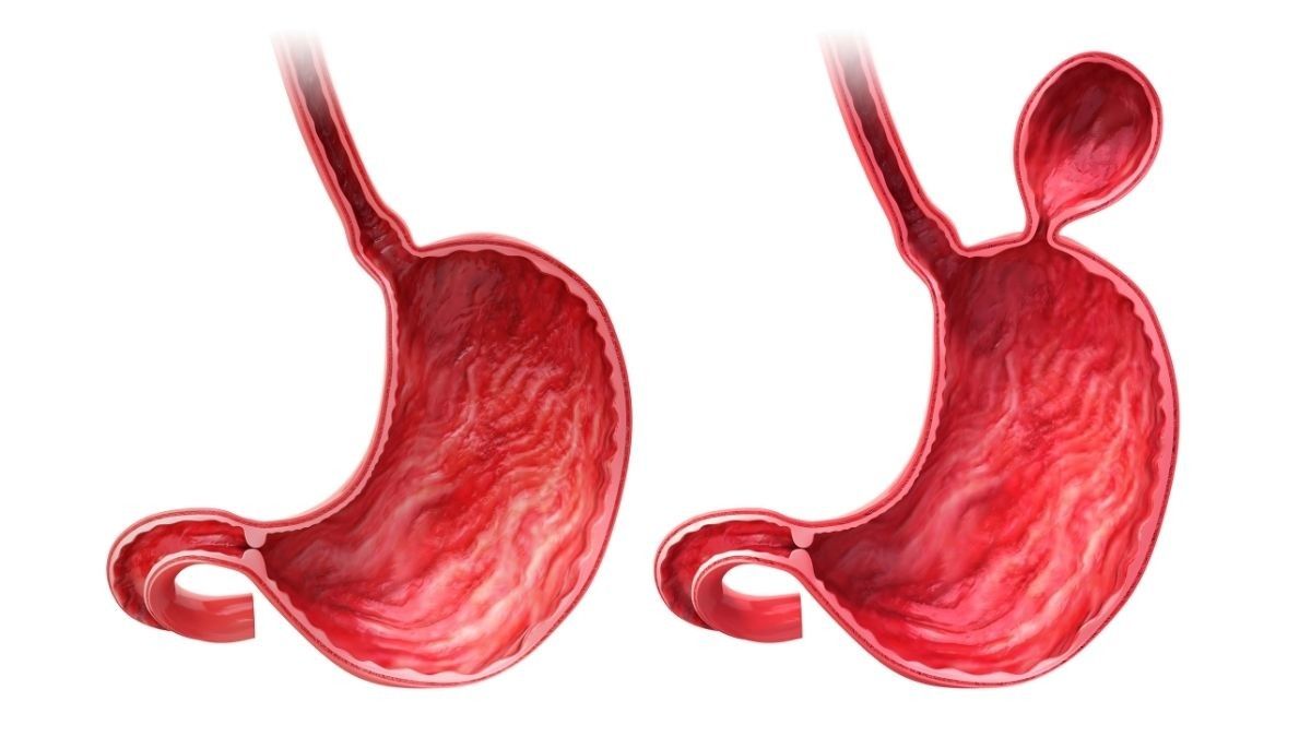 Mengapa Hernia Hiatus Tingkatkan Risiko GERD?