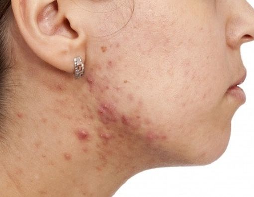 Mengatasi Jerawat Saat Kehamilan