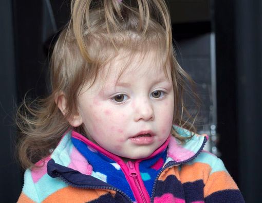 Cara Mengatasi Ruam Merah pada Kulit Anak