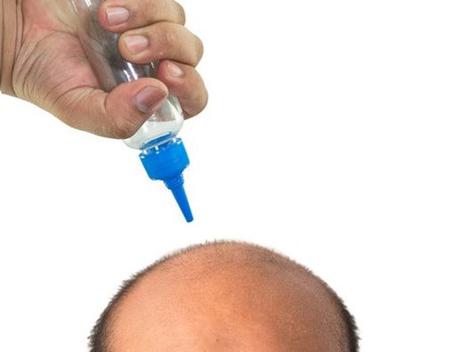 Perawatan untuk Kebotakan