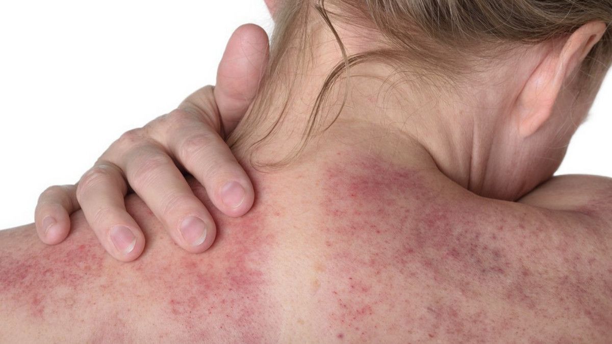 Bolehkah Kerokan Usai Operasi Caesar?