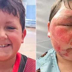 Akibat Ugal-Ugalan dalam Mengikuti Trends Media Sosial Anak 9 Tahun Mengalami Luka Bakar