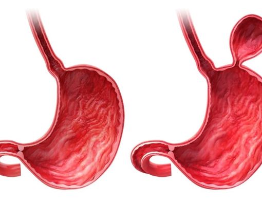Mengapa Hernia Hiatus Tingkatkan Risiko GERD?