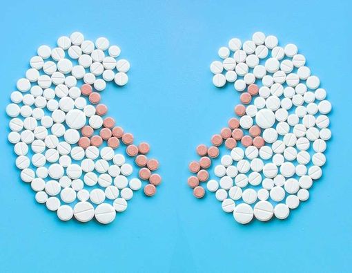 Hiperoksaluria Primer, Penyakit Langka Batu Ginjal Berulang