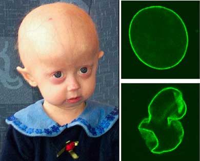 Penderita Progeria Kemungkinan Bisa Diobati