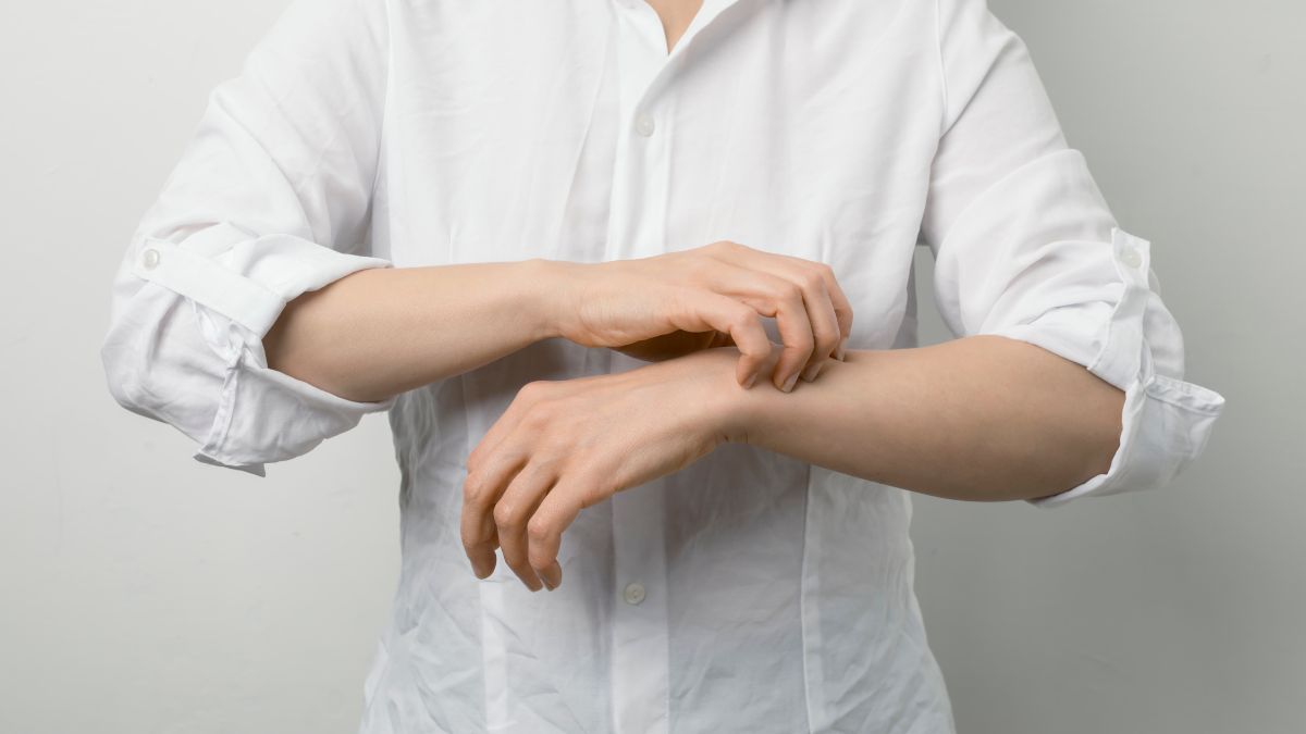 Hindari Kontak Kulit Langsung dengan Penderita Scabies