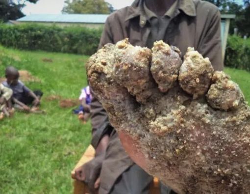 Penyakit Jiggers (Kutu Kecil) Bisa Mengakibatkan Kematian, Benarkah?