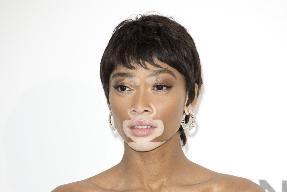 Kenali Vitiligo, Kelainan Warna Kulit yang Bikin Kulit Jadi Belang