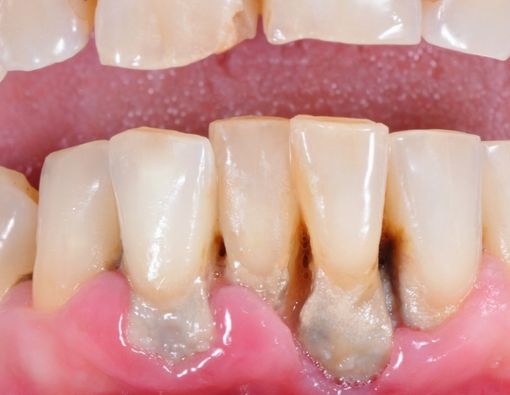 Jenis-Jenis Penyakit Periodontitis yang Harus Diketahui