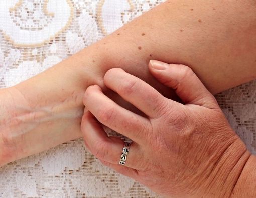 Luka Gatal di Kulit Jangan Digaruk, Ini Bahayanya