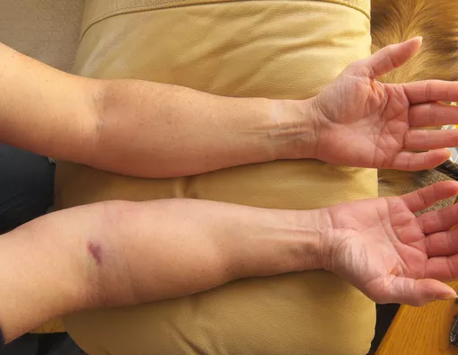 Tanda Limfadema yang Perlu Kamu Waspadai