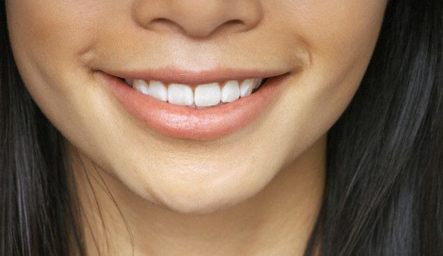 Lapisi Gigi, Dapatkan Senyum Indah