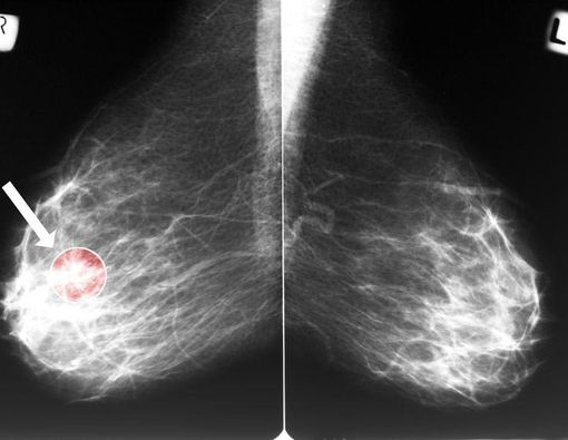 Cara Bedakan Benjolan Tumor dan Kanker pada Payudara