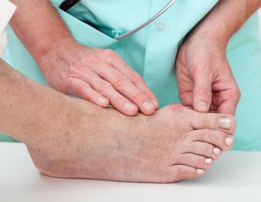 Penonjolan Tulang pada Osteoartritis