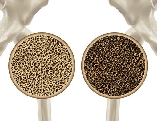 Cara Mencegah Osteoporosis